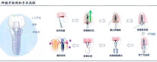 最新種植牙技術介紹,最新種植牙技術介紹，自信微笑，從心開始